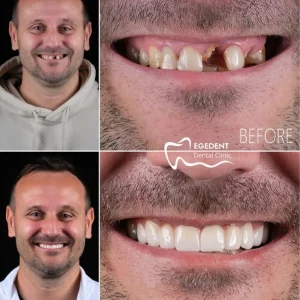 EGEDENT BEFORE AFTER 001