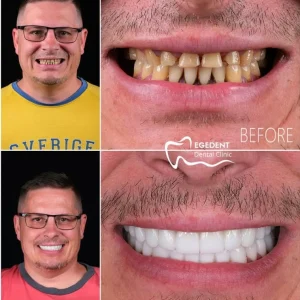 EGEDENT BEFORE AFTER 002