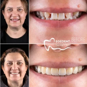 EGEDENT BEFORE AFTER 003