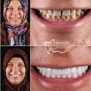 EGEDENT BEFORE AFTER 004