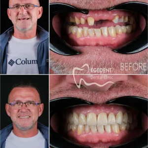 EGEDENT BEFORE AFTER 005