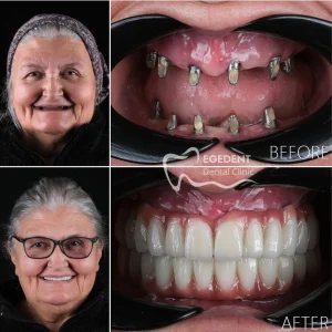 EGEDENT BEFORE AFTER 006