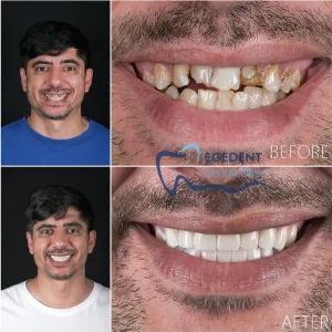 EGEDENT BEFORE AFTER 007